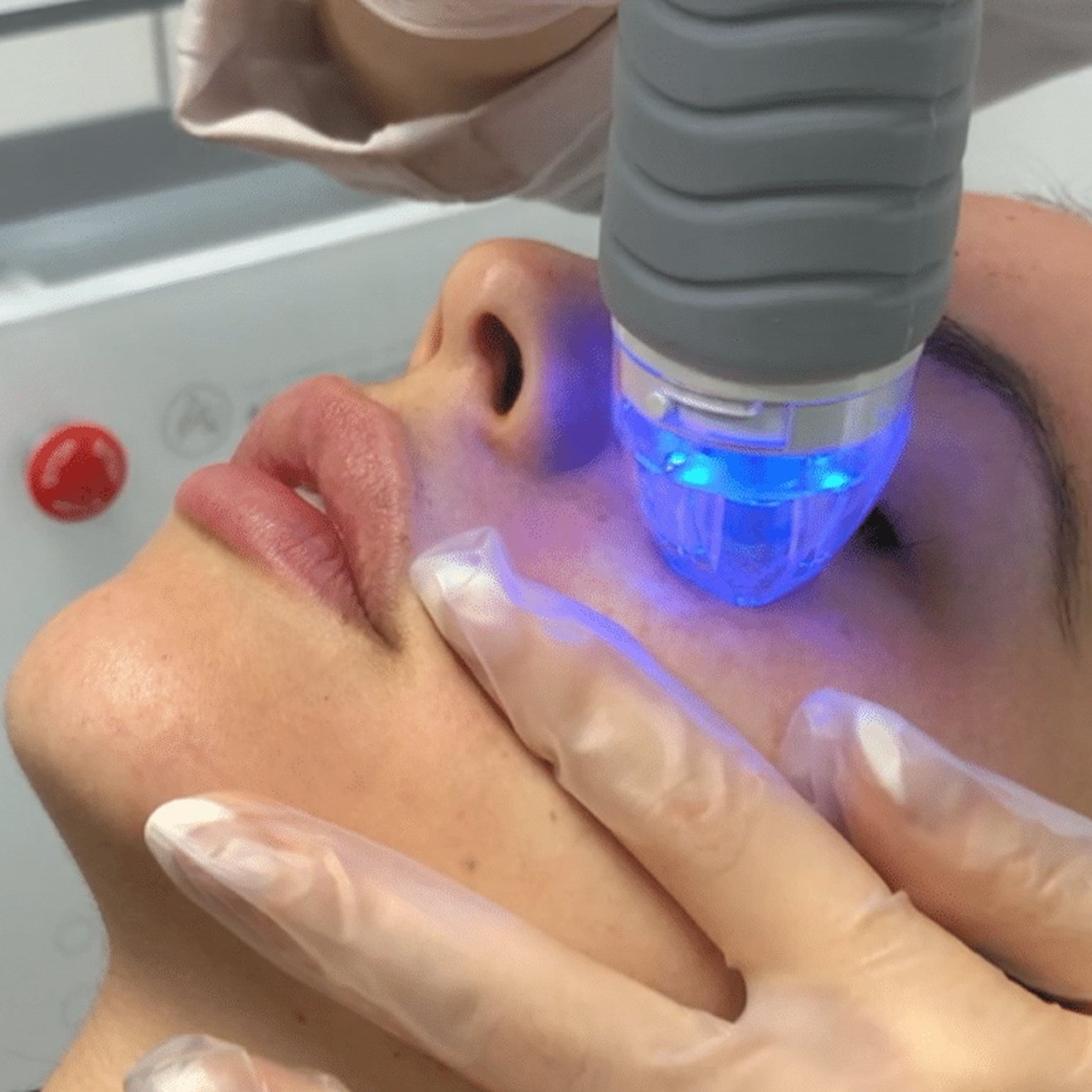 Fractional Microneedling