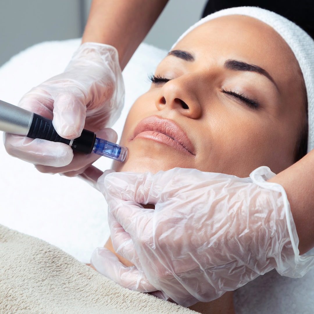 Microneedling